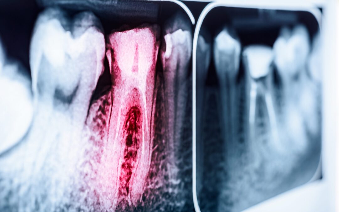 Radiografia dentale